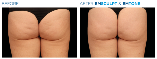 EmsculptNeo & Emtone