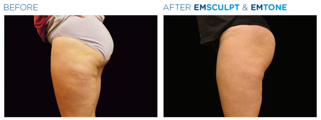 EmsculptNeo & Emtone