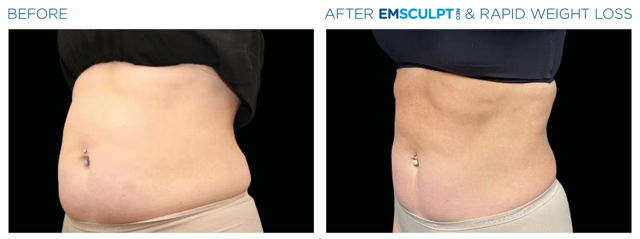 Medical Weight Loss & EmsculptNeo