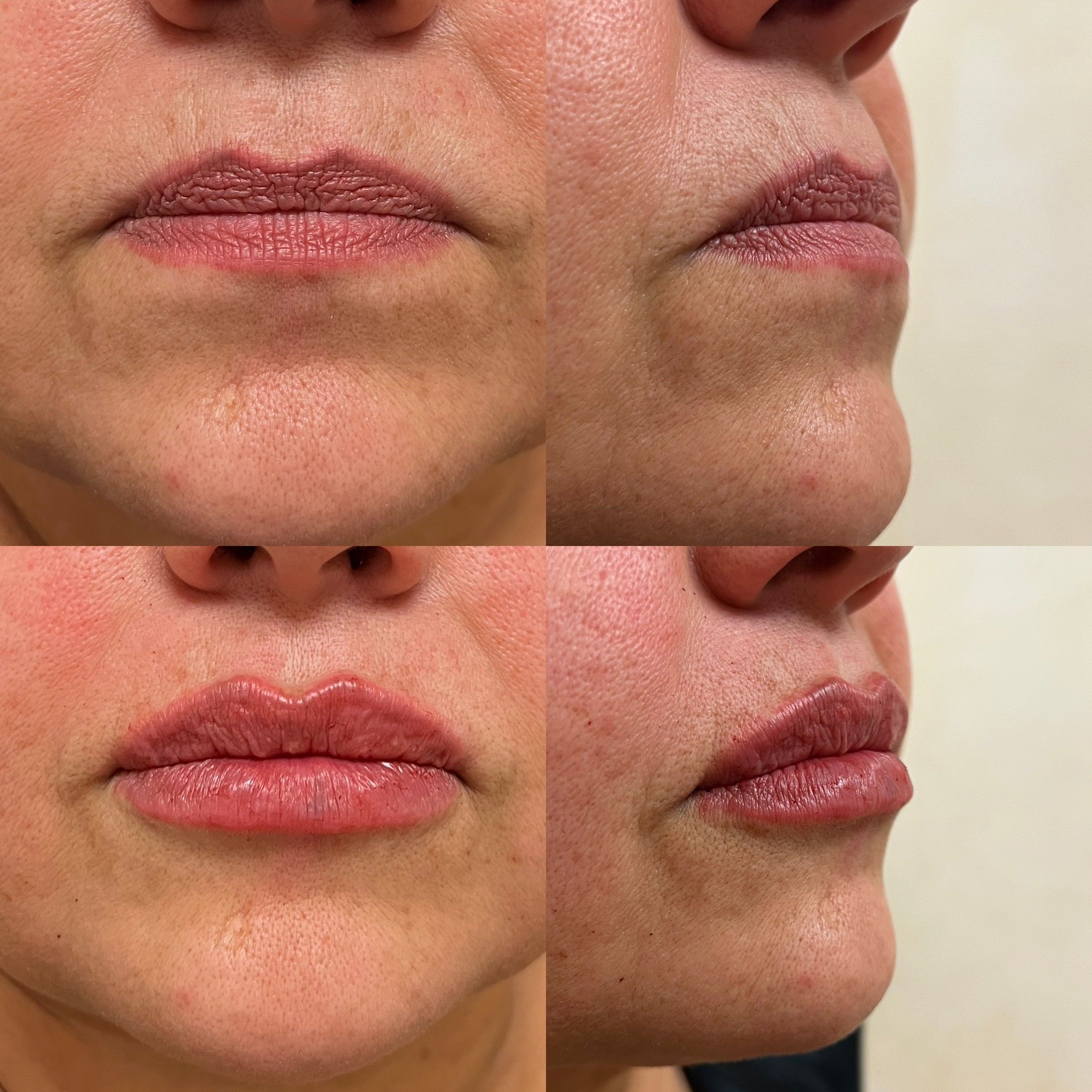 Fresh lips, instantly 💋✨

These lip filler results are shown immediately after treatment at Flawless Aesthetics in Wilsonville. You may notice a little swelling right after injections, but this gives you a preview of the beautiful shape and volume w