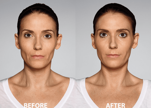 Facial Balancing Filler