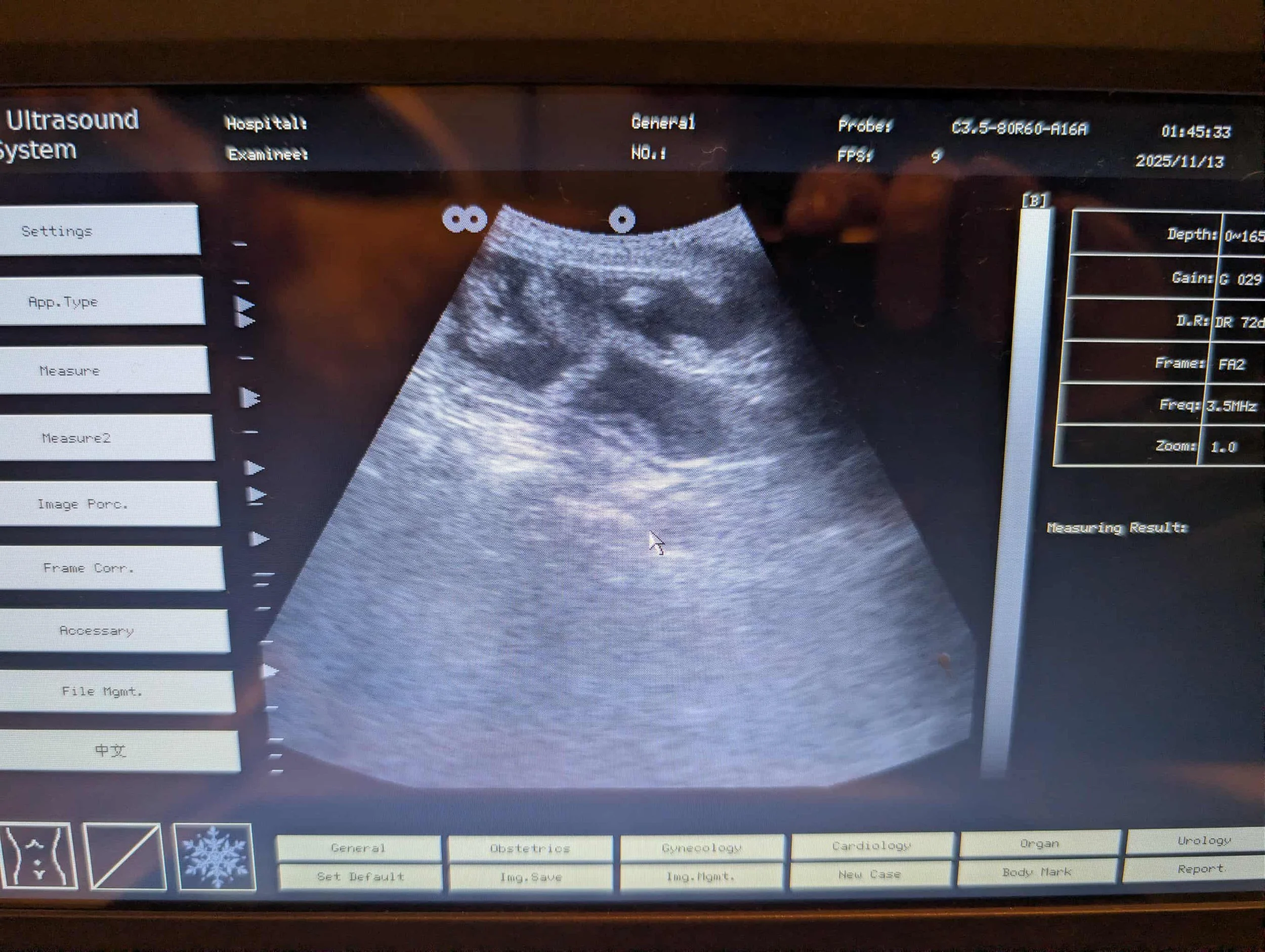 Ultrasound monitor displaying a black and white image of internal body structures, likely in a medical setting.