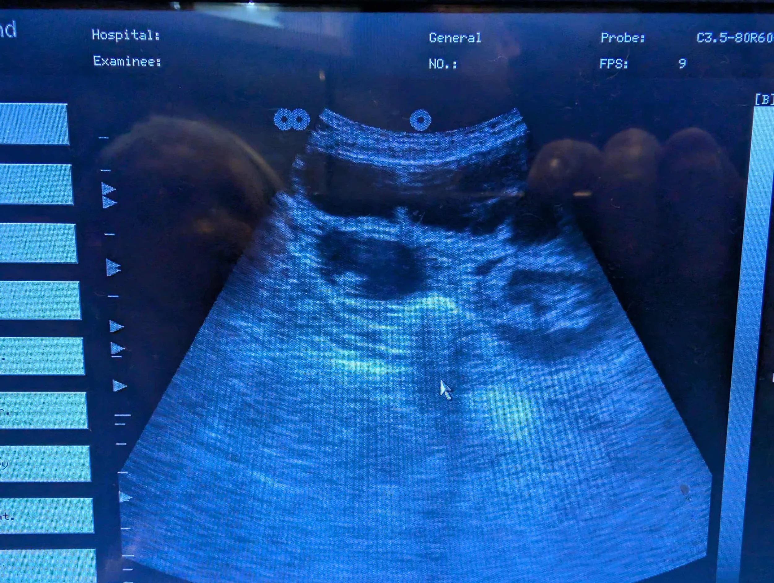 Ultrasound image showing a developing fetus inside the womb.