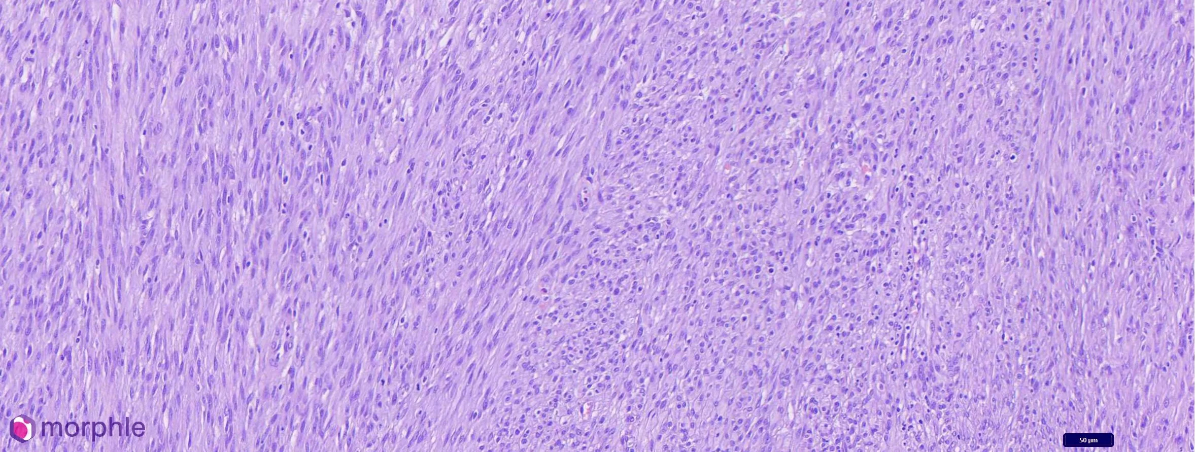 Soft Tissue Sarcomas: What the Category Includes, What the Grade Means, and Why Subtype Often Cannot Be Determined