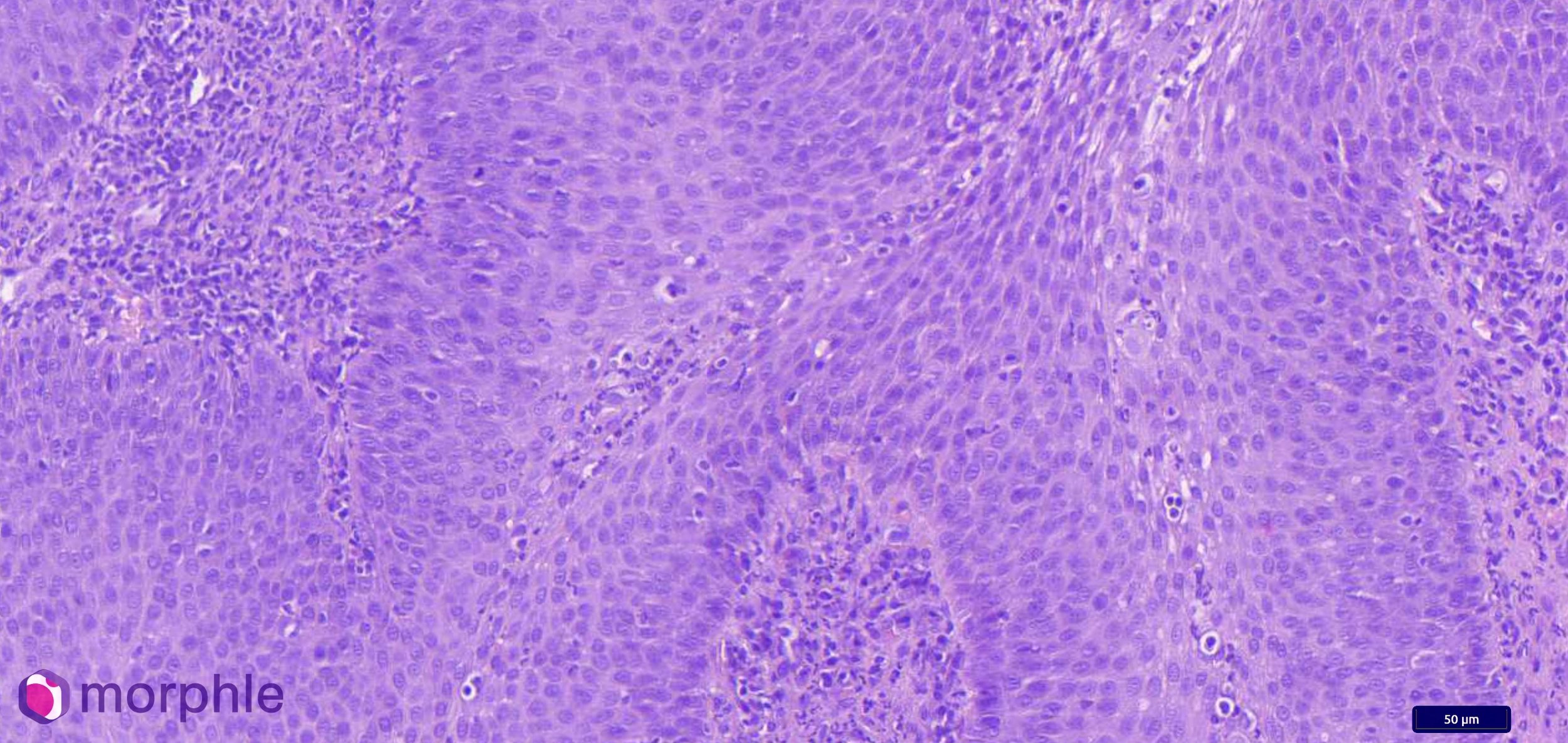 When CAA Isn't CAA: A Second Opinion Case of Oral Papillary Squamous Cell Carcinoma