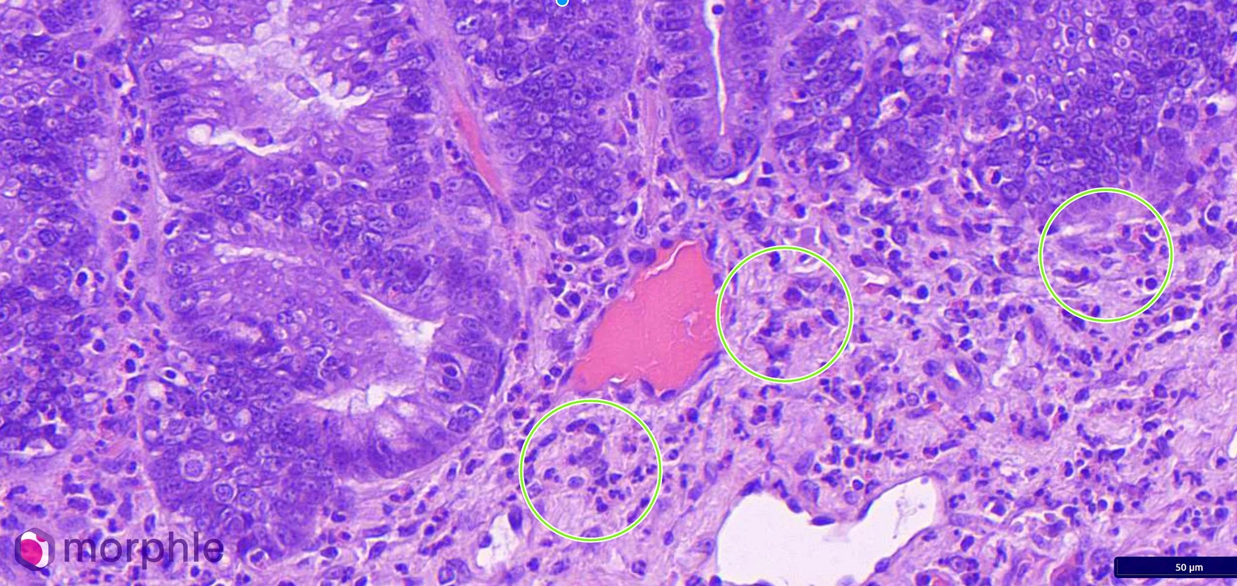 histopathology image of intestine with eosinophils