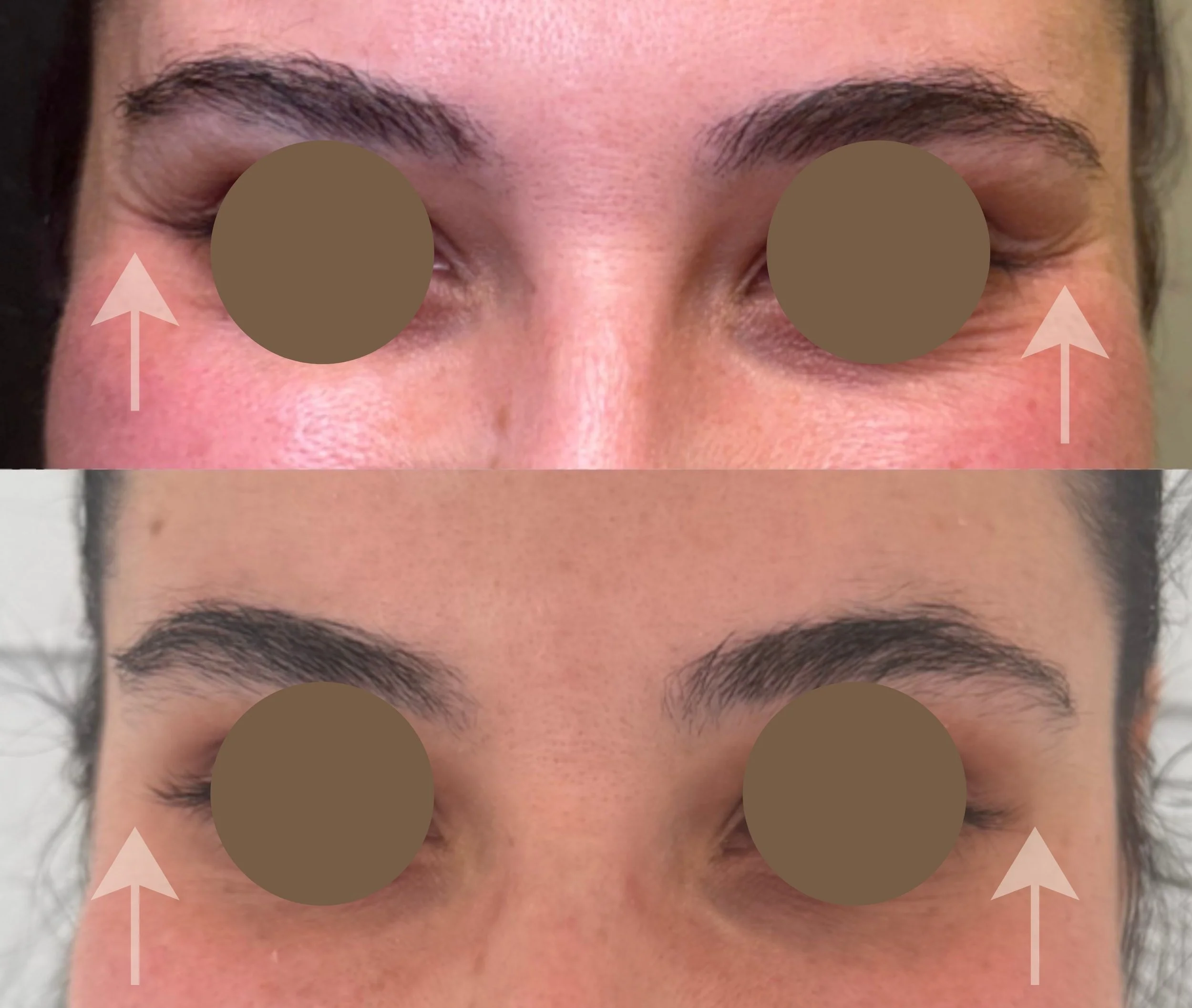 Crow's Feet Neuromodulator (Xeomin®)