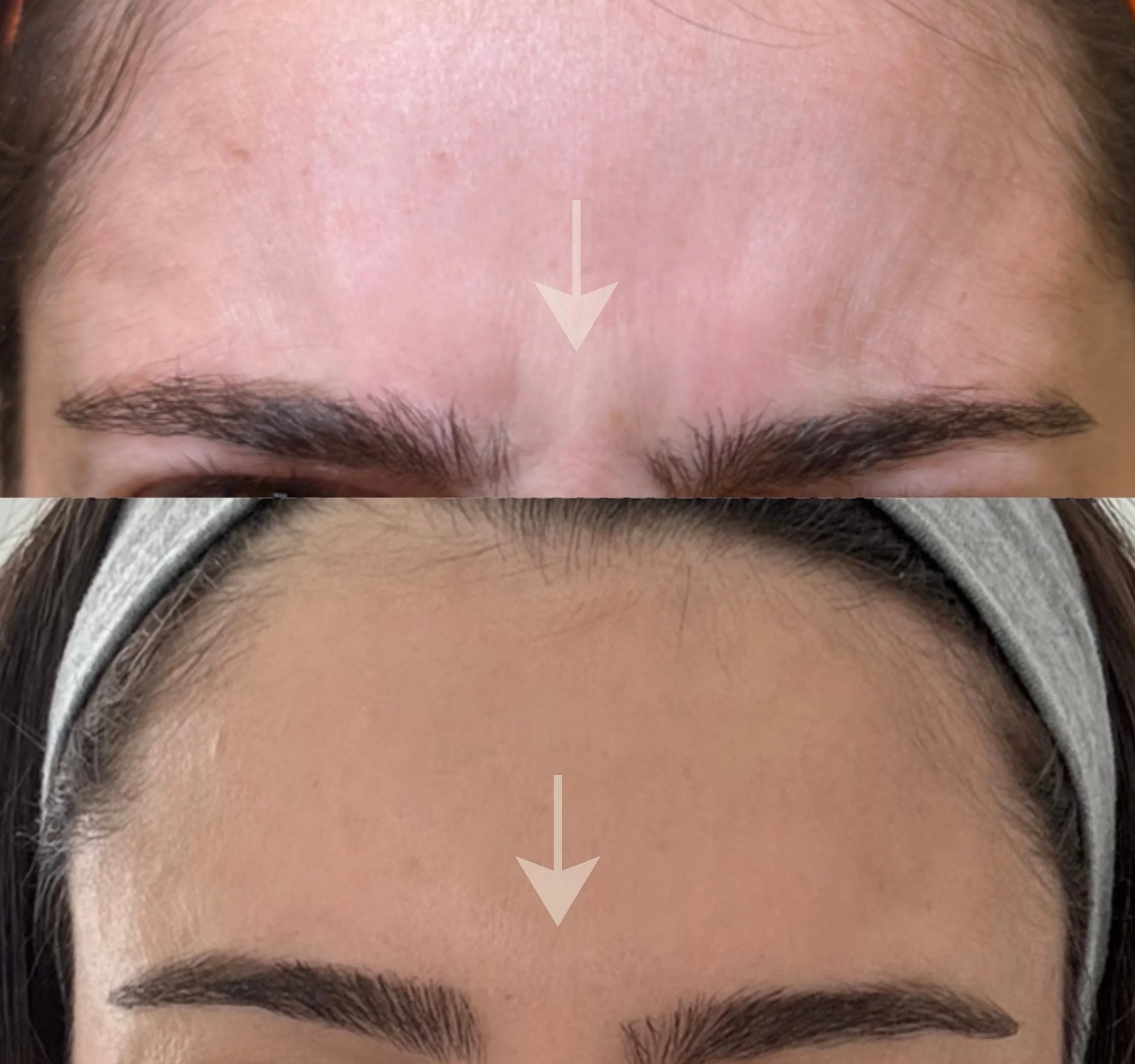 Glabella Neuromodulator (Xeomin®)