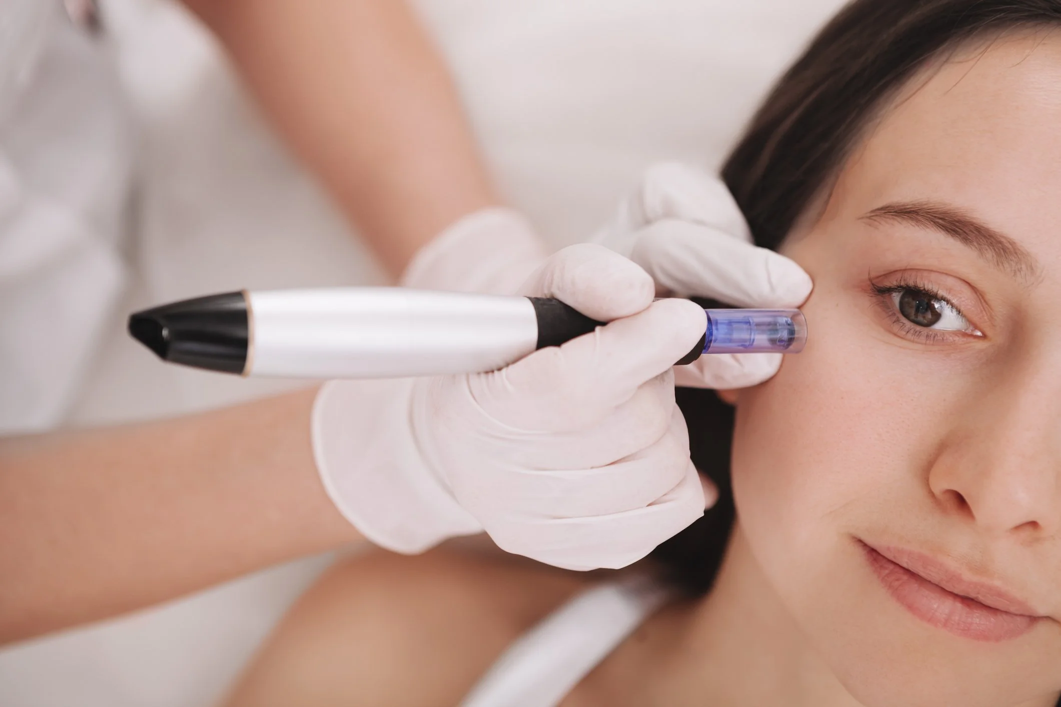 Microneedling example