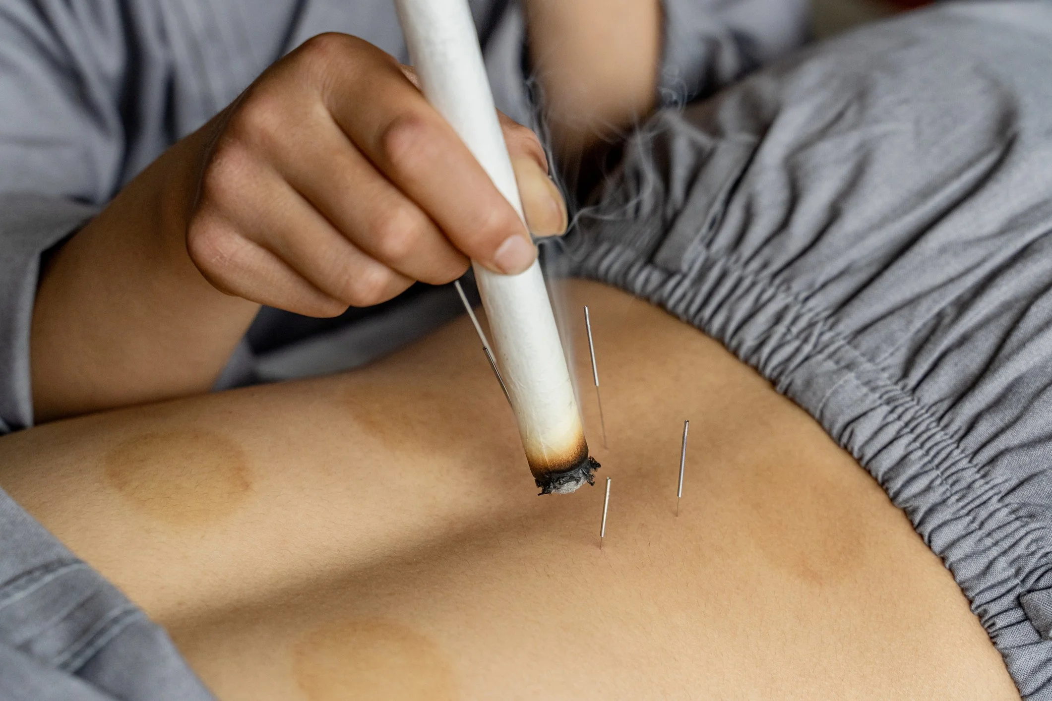 Moxibustion: a warm, healing therapy
