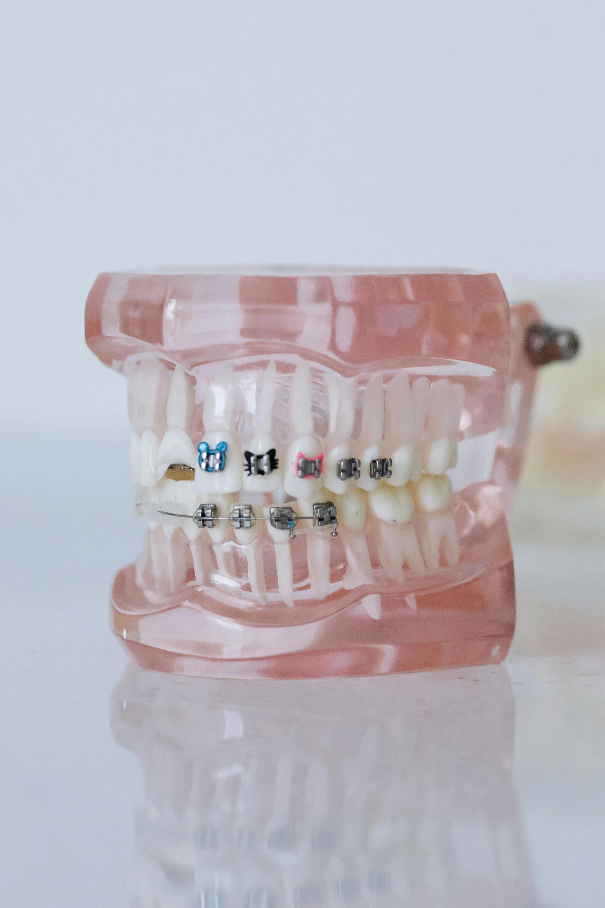 Braces (Metal & Ceramic)