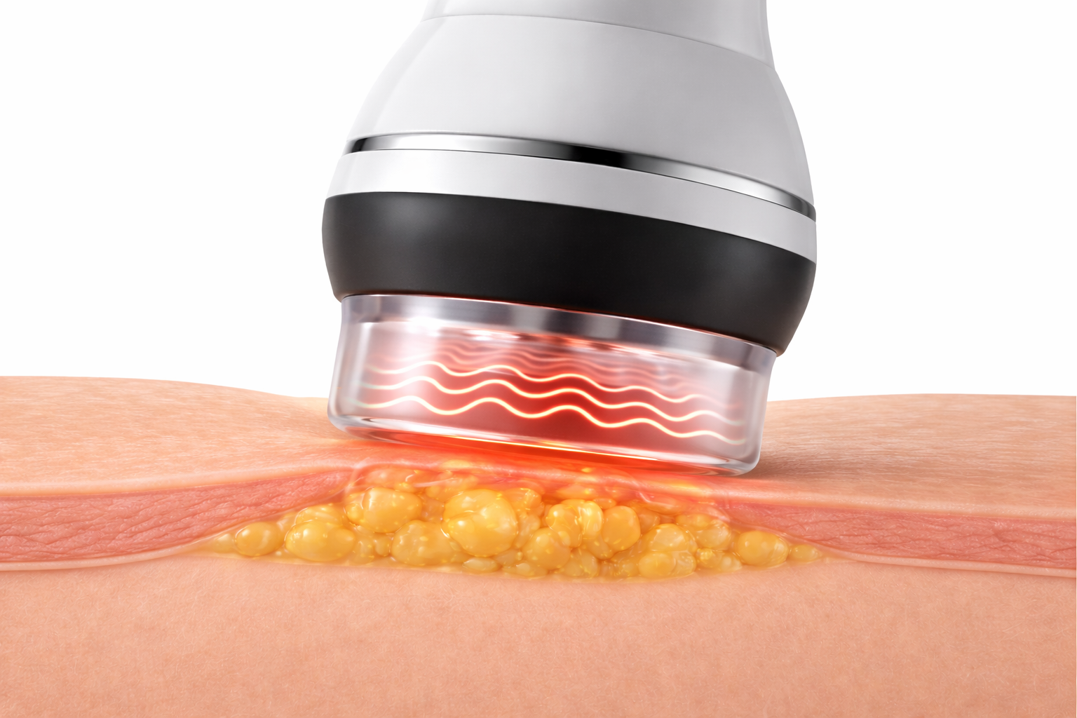 Close-up of a medical device using light therapy on a cluster of yellow fat cells beneath human skin.
