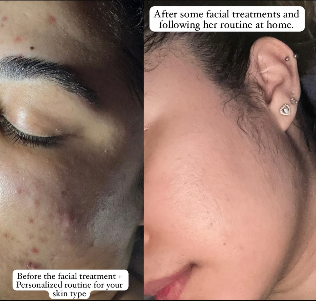 ✨ Real transformation ✨
Transforming your skin step by step 💆&zwj;♀️
With facial treatments + a personalized home routine 🧴=Results 

Consistency is the key to reach your goal 🌸
Taking care of your skin is self-love 💖
#skintransformations  #facia