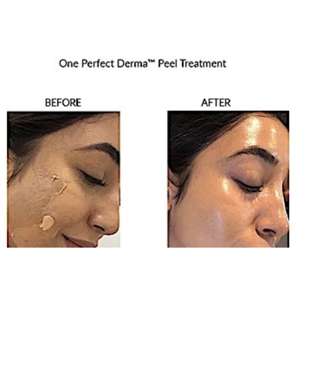 Results after 1 microneedling with PRP and 1 microneedling with PDRN - 5.png