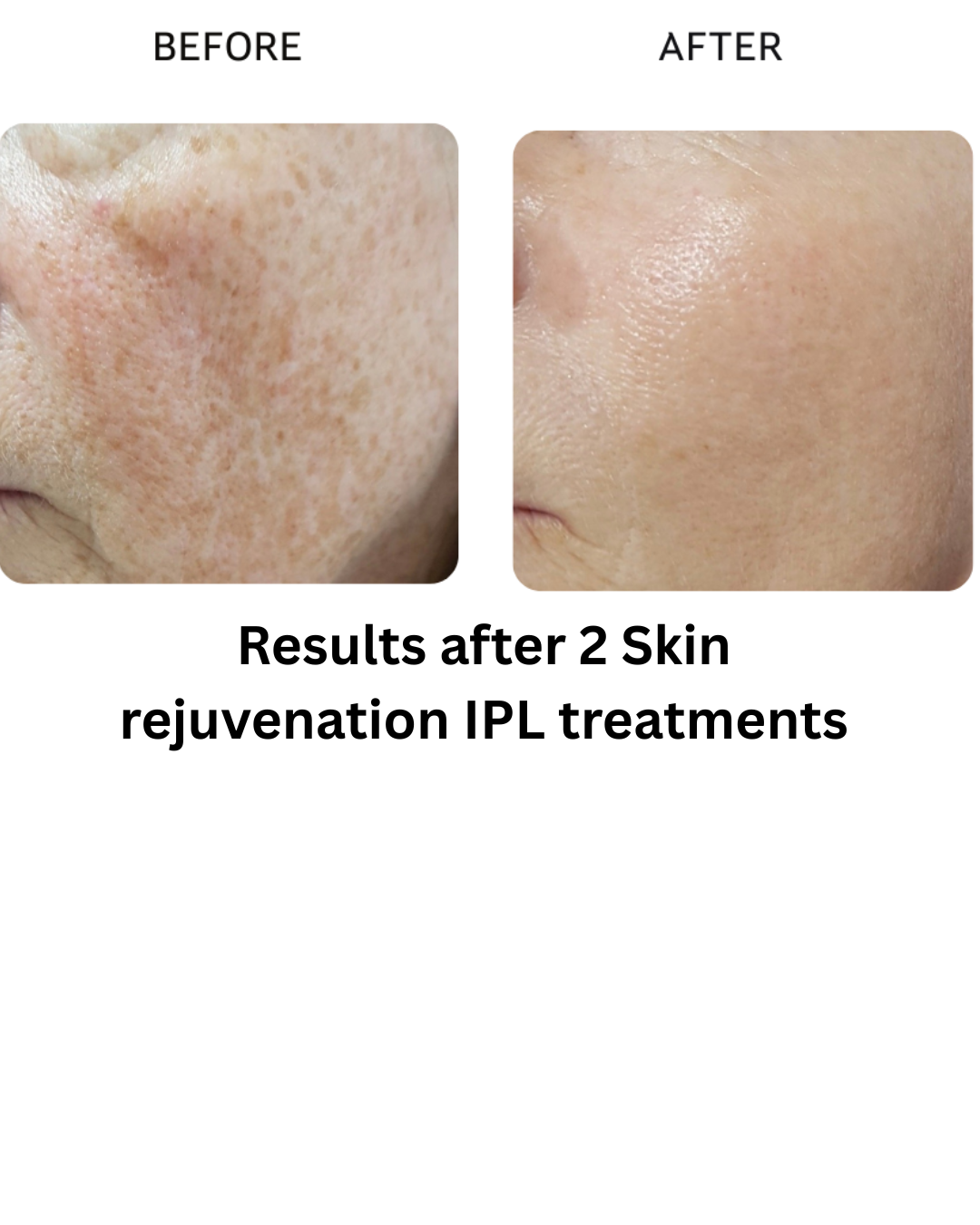 Results after 3 skin resurfacing treatments - 3.png