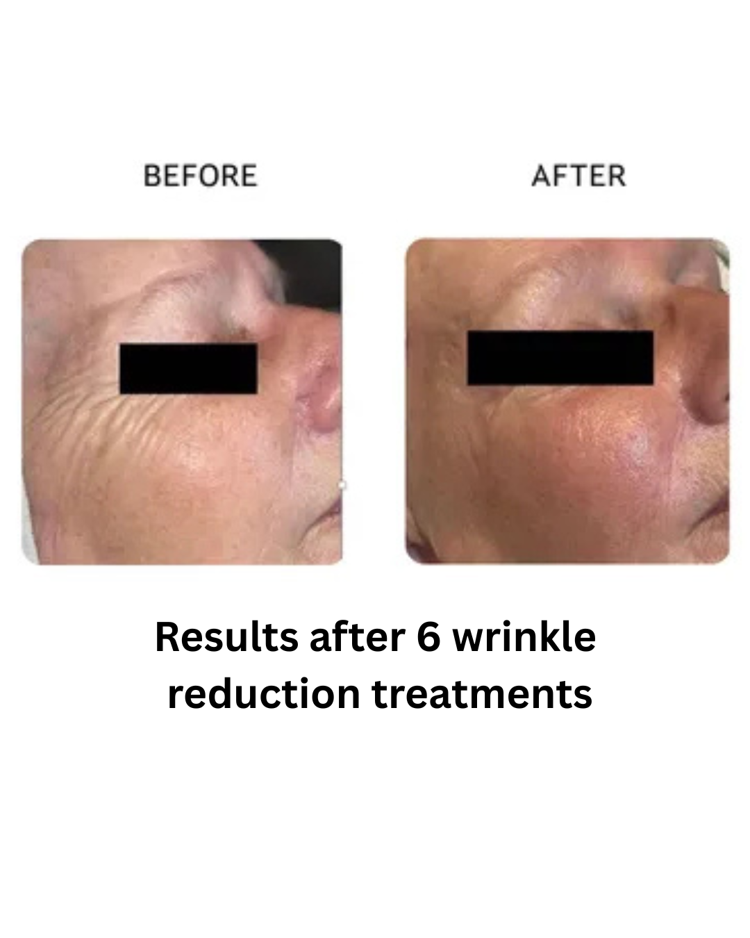 Results after 6 wrinkle reduction treatments - 1.png
