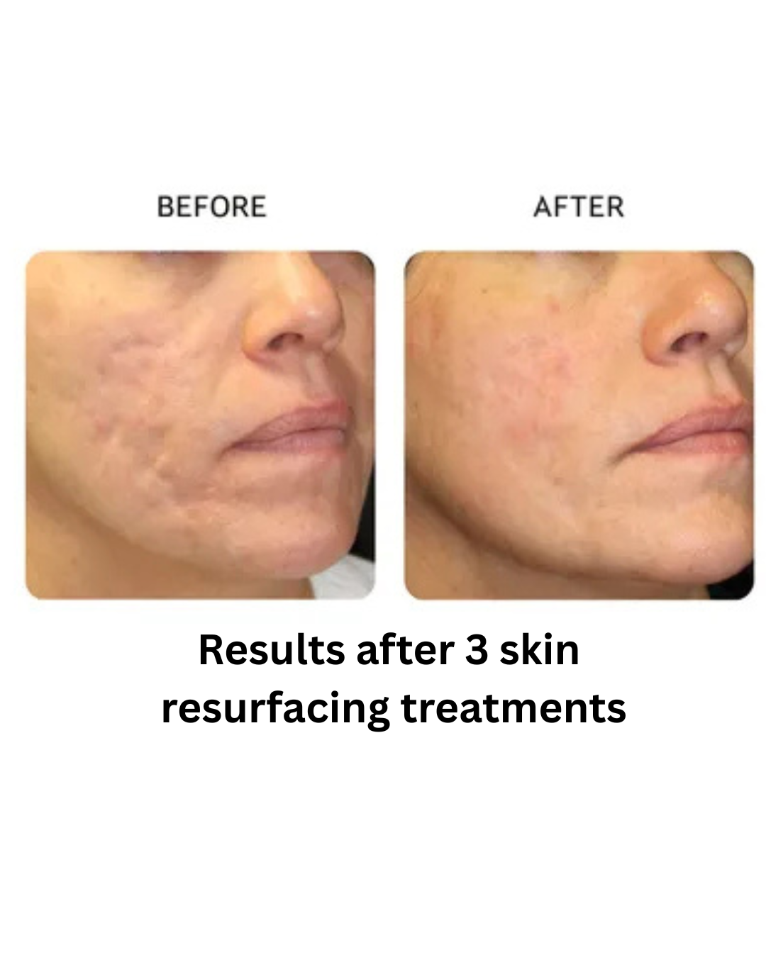 Results after 6 wrinkle reduction treatments - 2.png