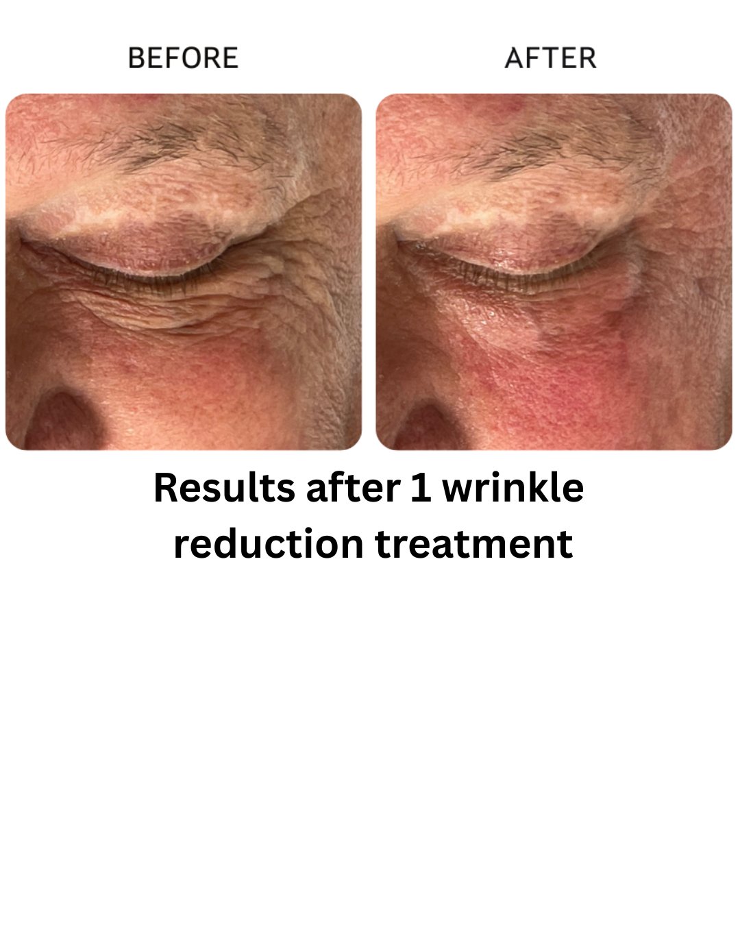 Results after 3 skin resurfacing treatments - 2.png