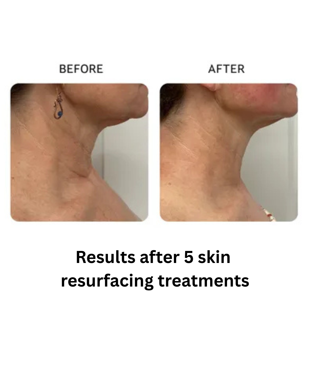 Results after 6 wrinkle reduction treatments - 3.png