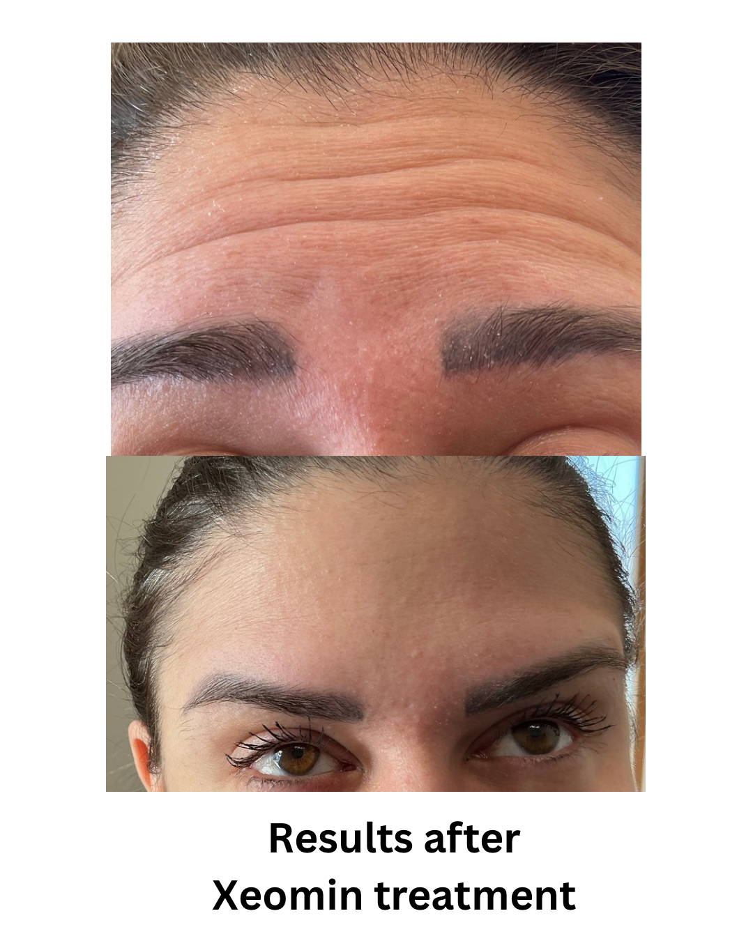 Results after Xeomin treatment - 3.png
