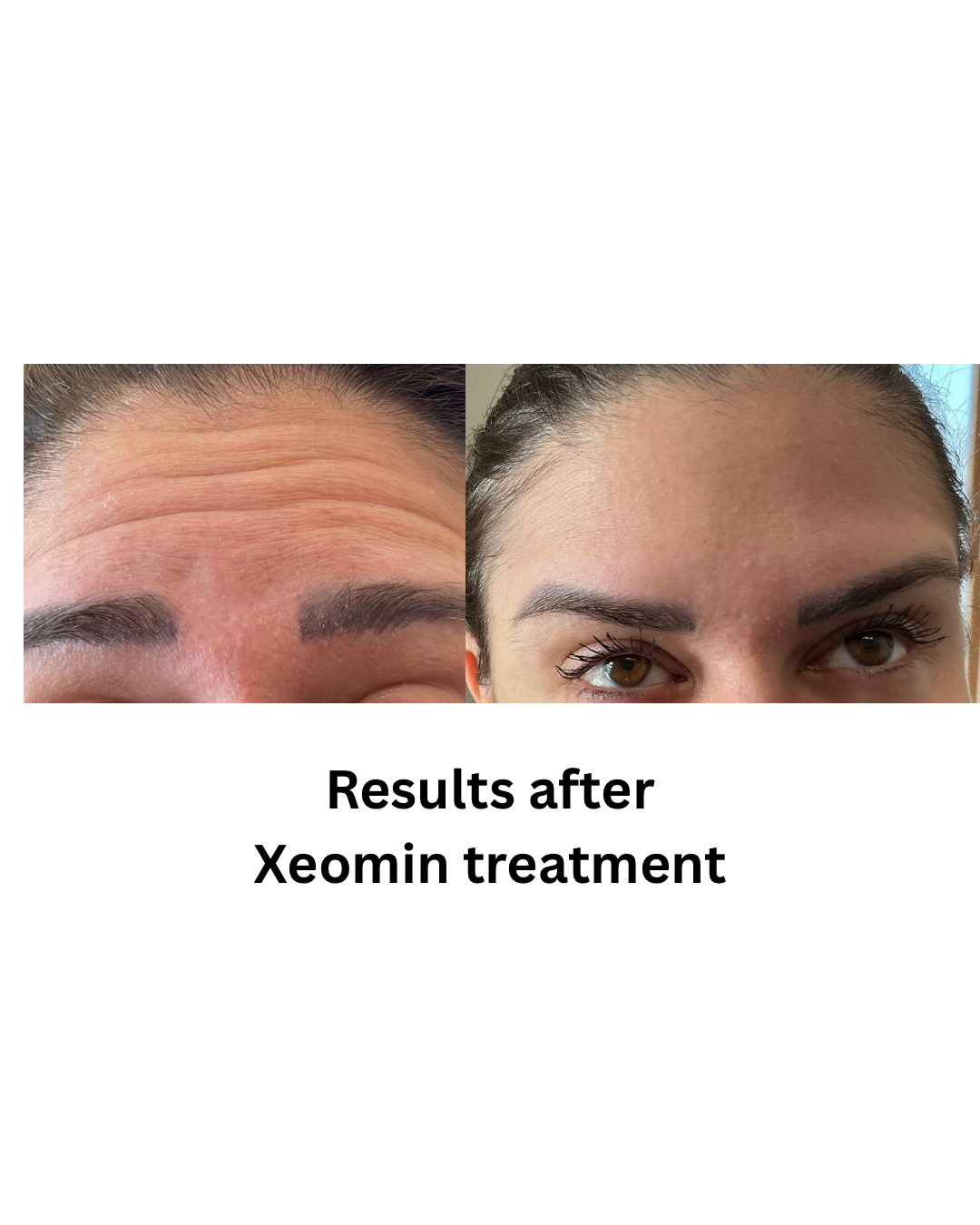 Results after Xeomin treatment - 3.png