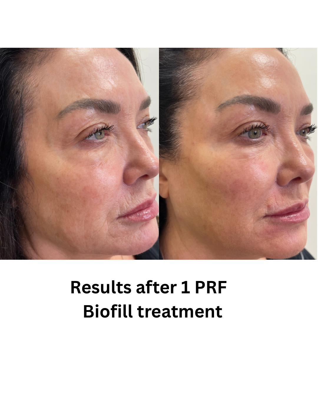 Results after Xeomin treatment - 1.png