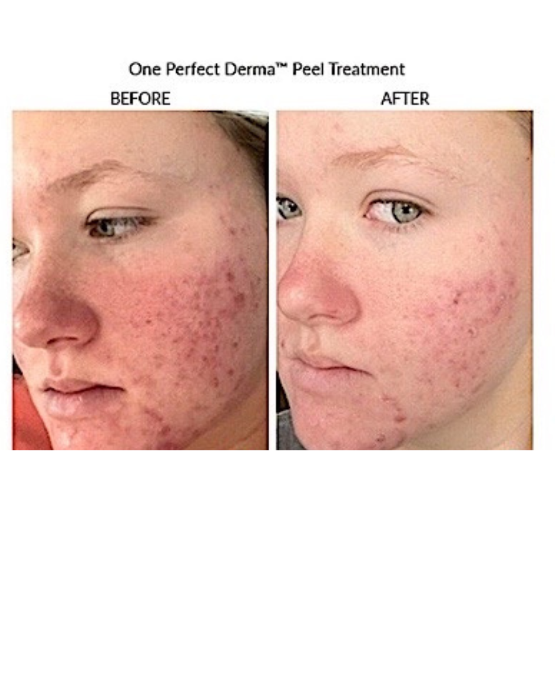 Results after 1 microneedling with PRP and 1 microneedling with PDRN - 4.png