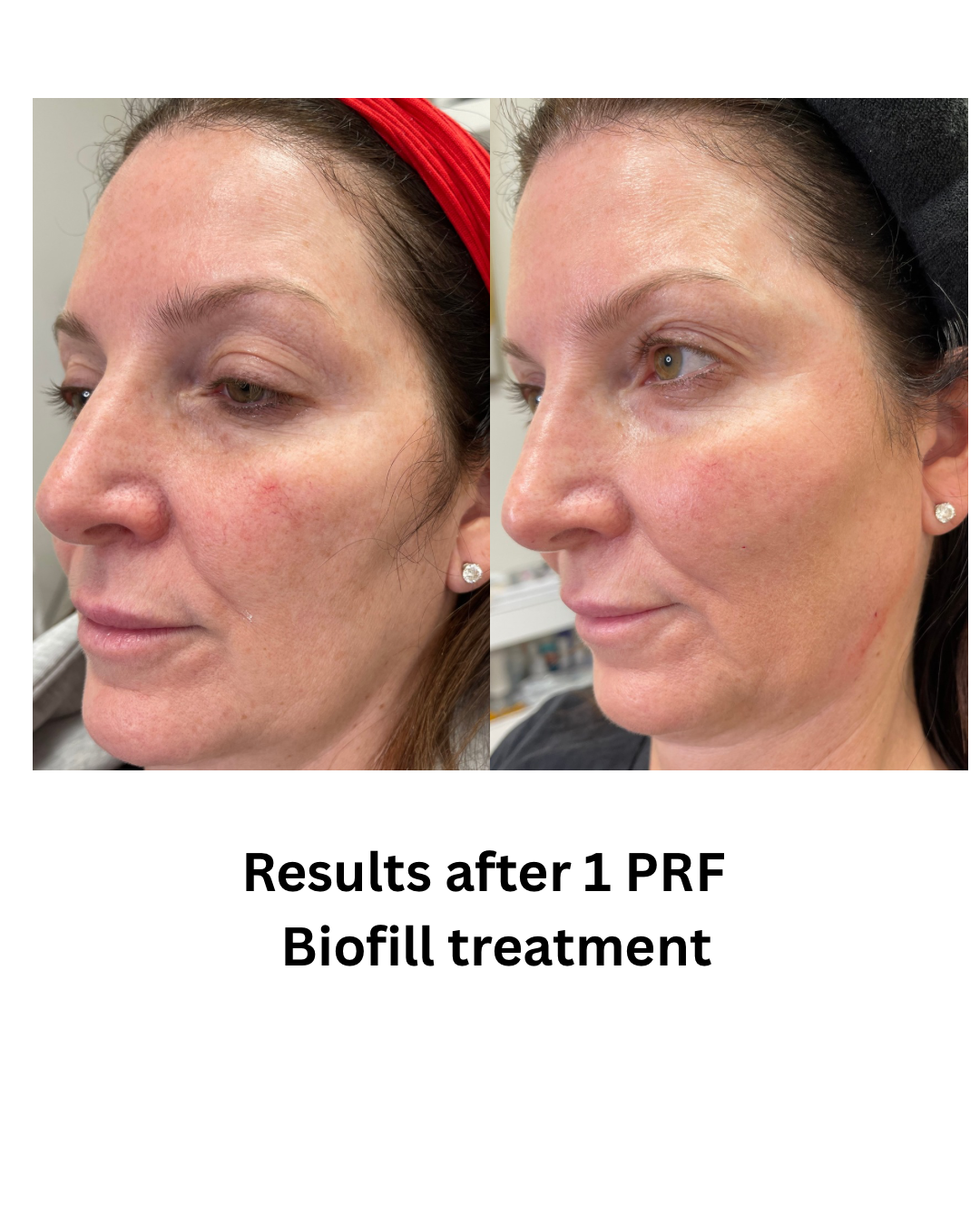 Results after Xeomin treatment - 2.png