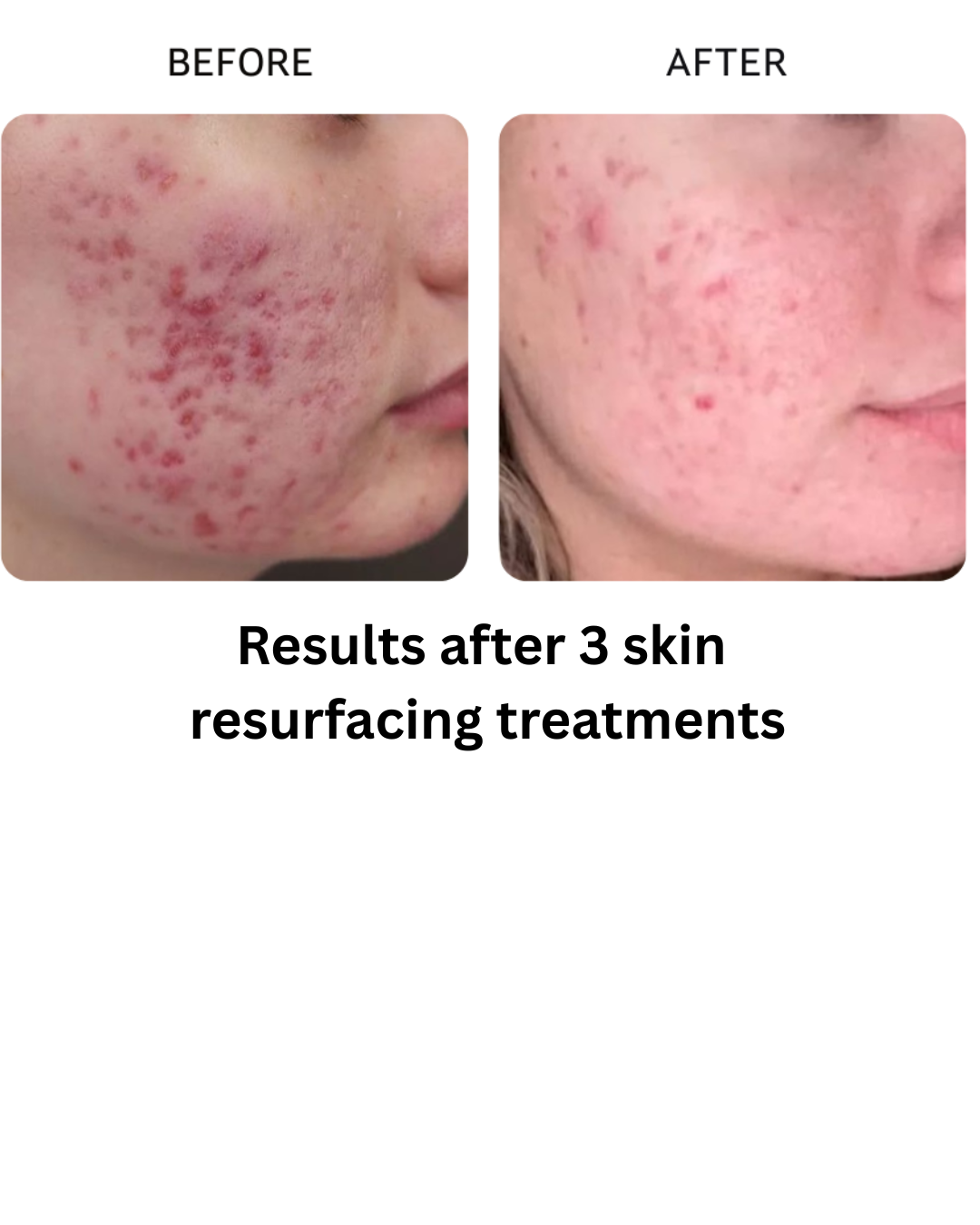 Results after 3 skin resurfacing treatments - 1.png