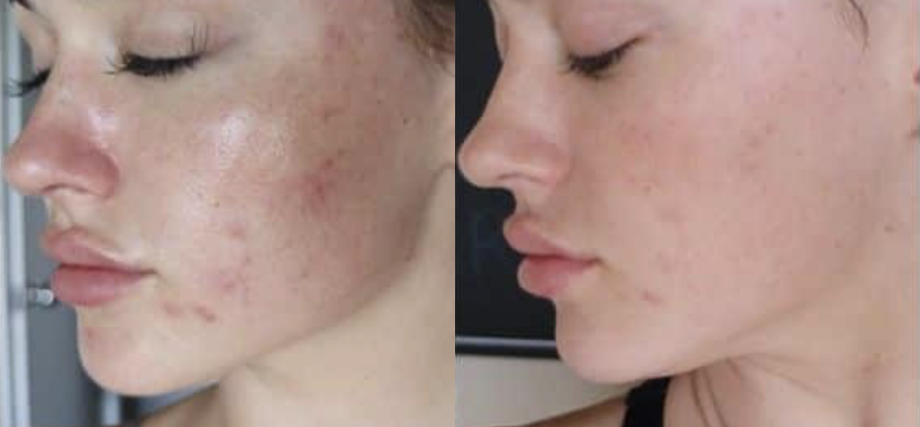 PRP-Facial-Rejuvenation