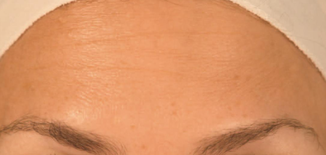 Forehead Lines Before
