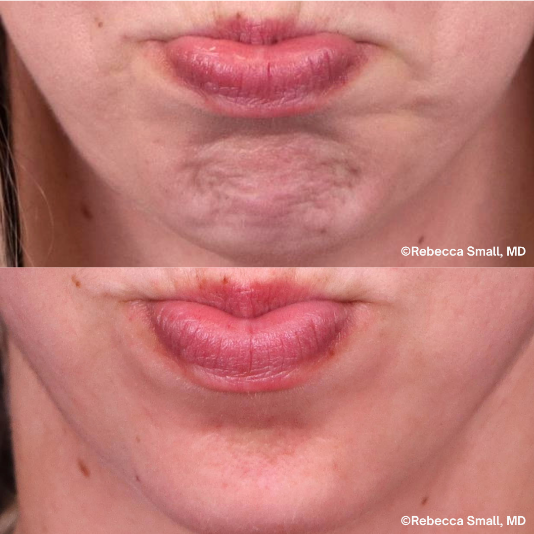 Chin Lines
