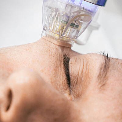 Close-up of a person receiving a facial treatment with a device applied to their forehead.