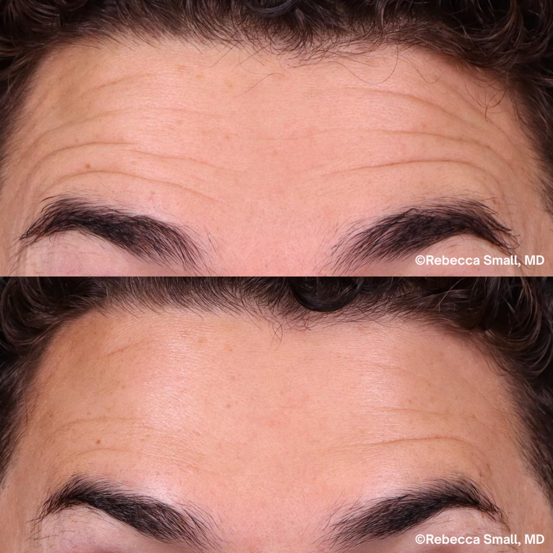 Forehead Lines