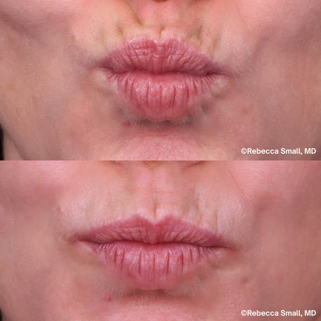 Upper Lip Lines