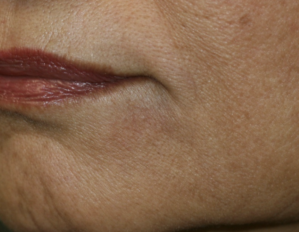 Marionette Lines Before