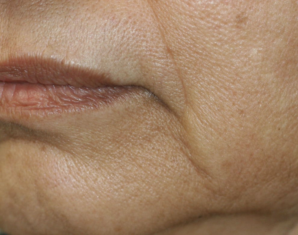 Marionette Lines Before