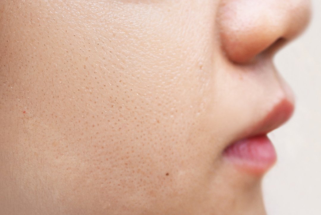 Textured Skin Treatment