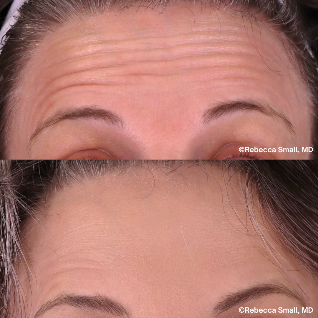 Forehead Lines