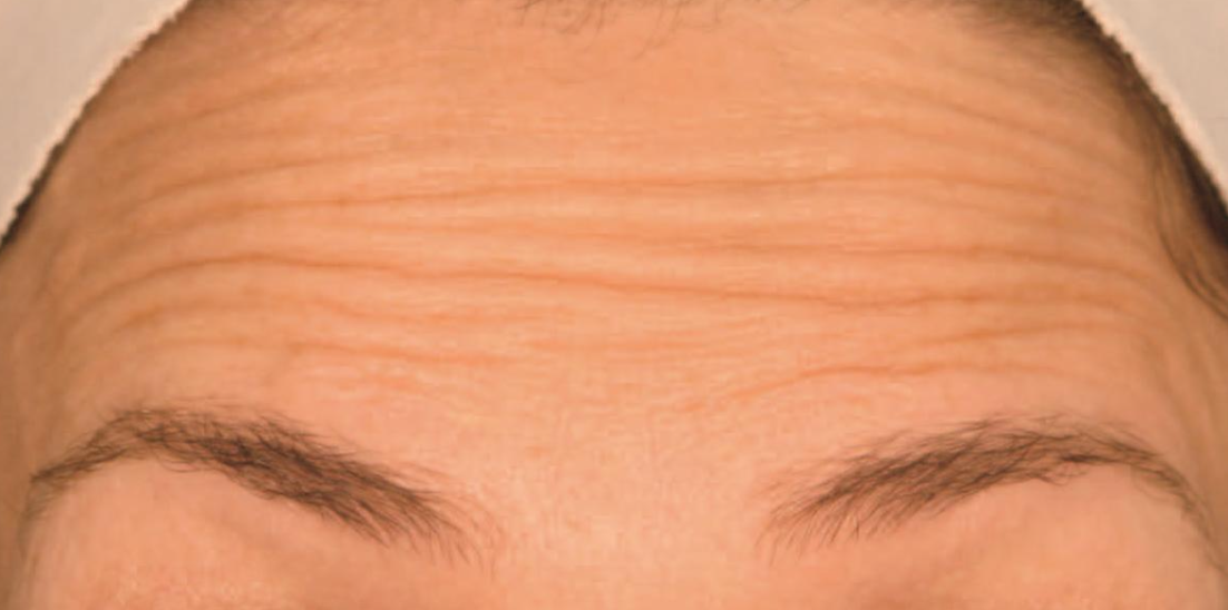 Forehead Lines Before