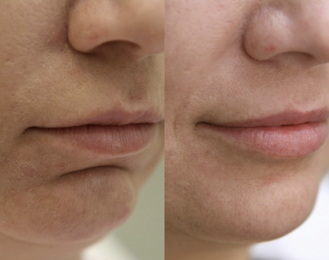 Dermal Filler