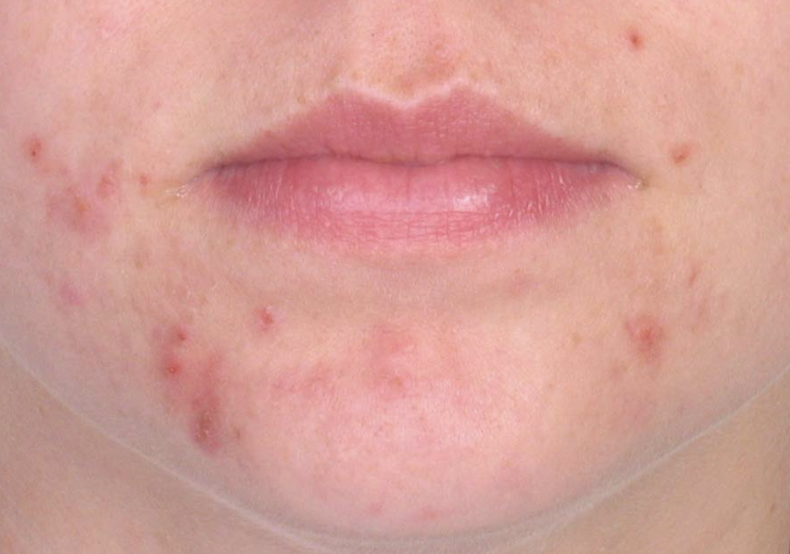 Acne Before