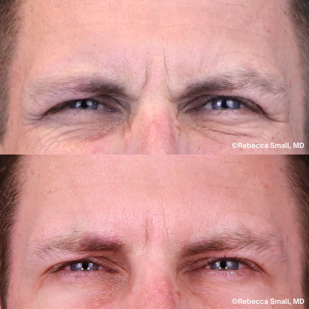 Frown Lines