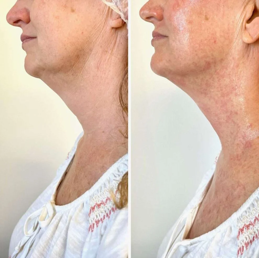 Side-by-side comparison of a woman's neck and lower face before and after a skincare treatment, showing improved skin texture and reduced sagging.
