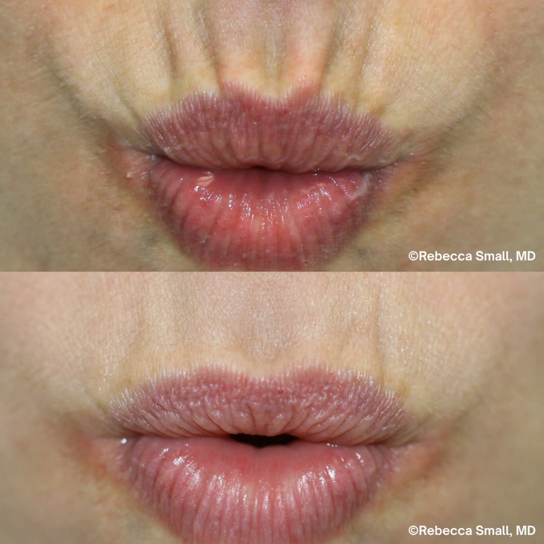 Upper Lip Lines