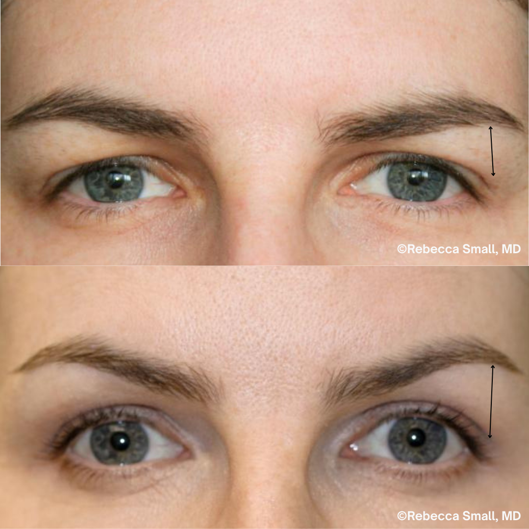 Brow Lift