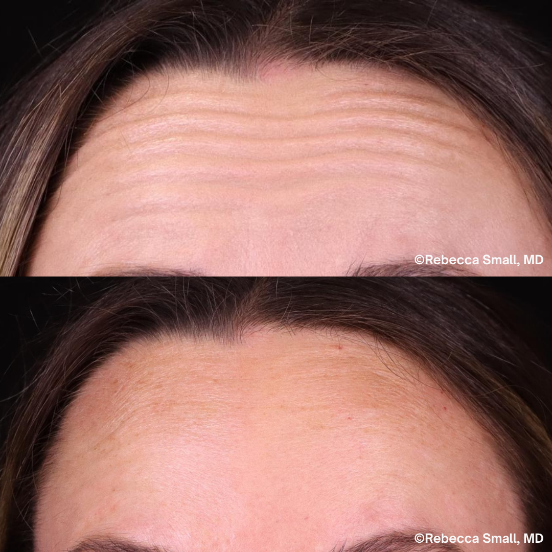 Forehead Lines