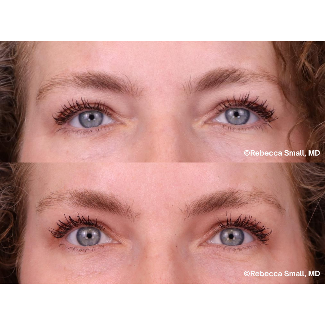 Brow Lift