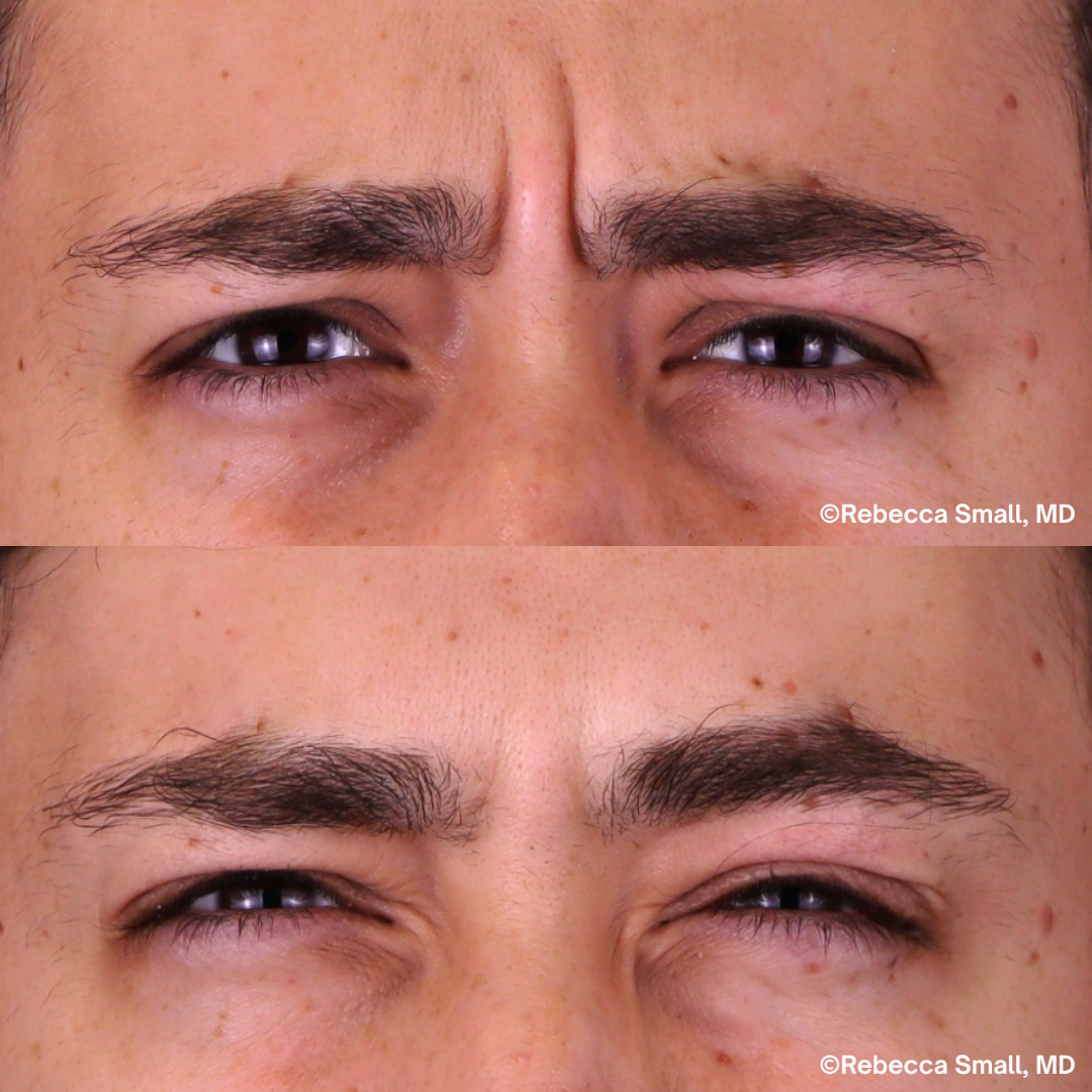 Frown Lines