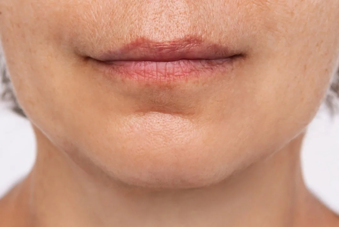 Volume Loss Treatment